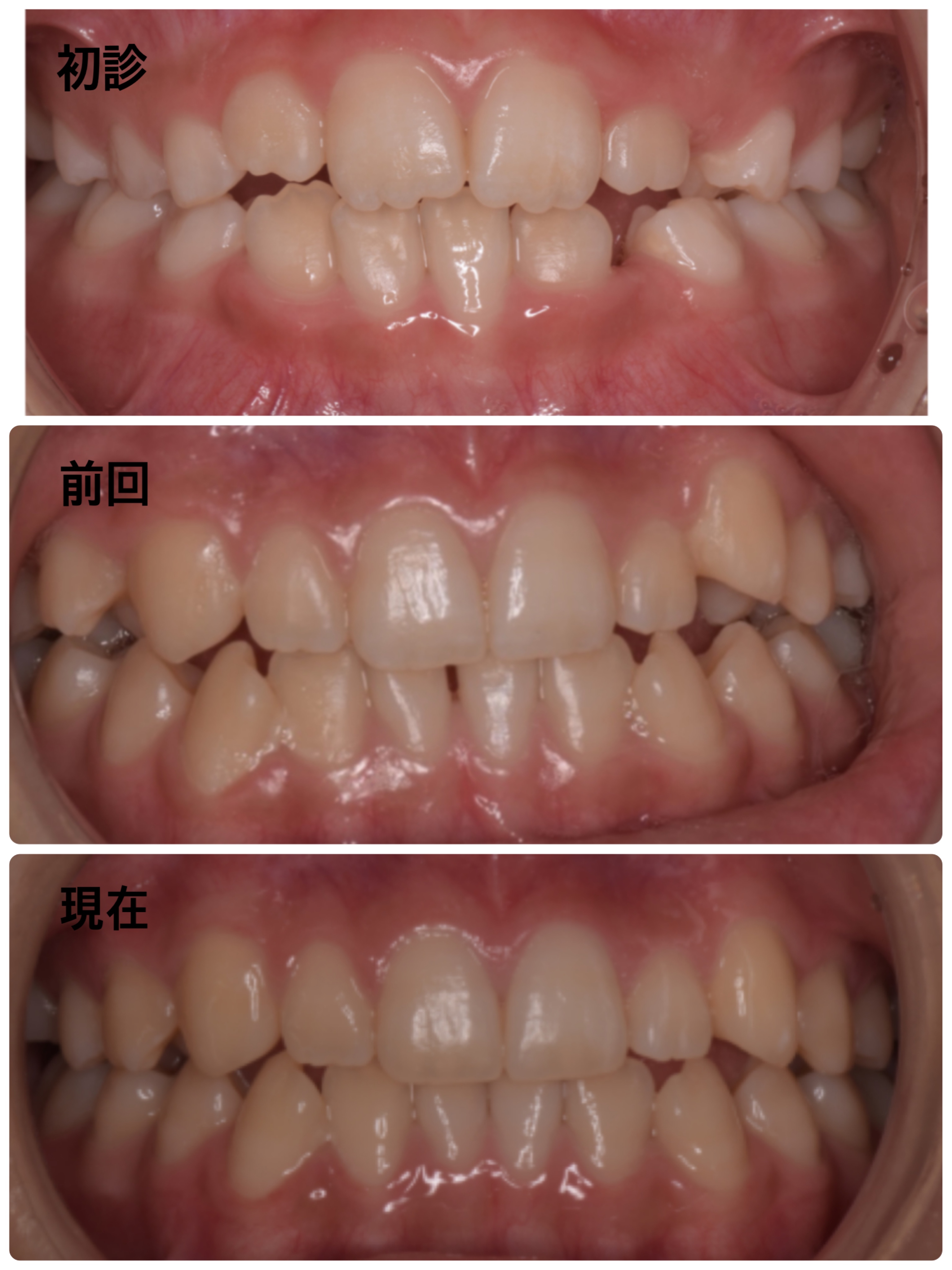 小児矯正④