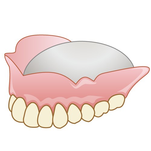 金属床義歯について