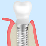 STEP7： 人工歯の装着